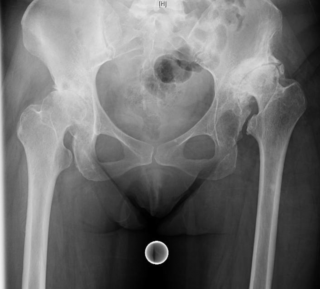 Complex THA for Severe Hip Dysplasia Darwin Chen, MD