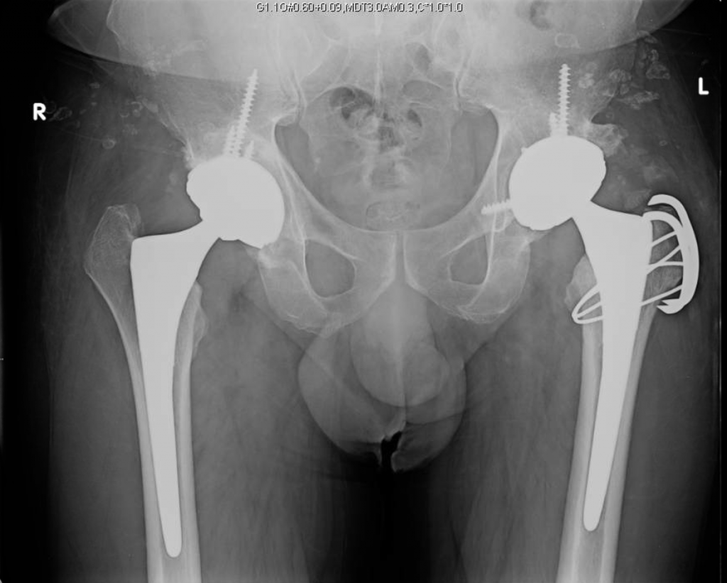 Hip Fusion Conversion to THA Darwin Chen, MD