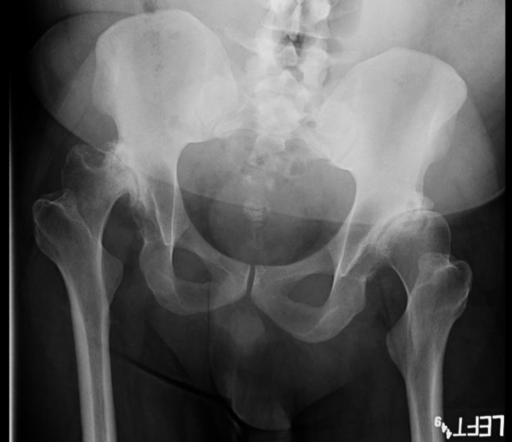 Severe Hip Dysplasia THA Darwin Chen, MD