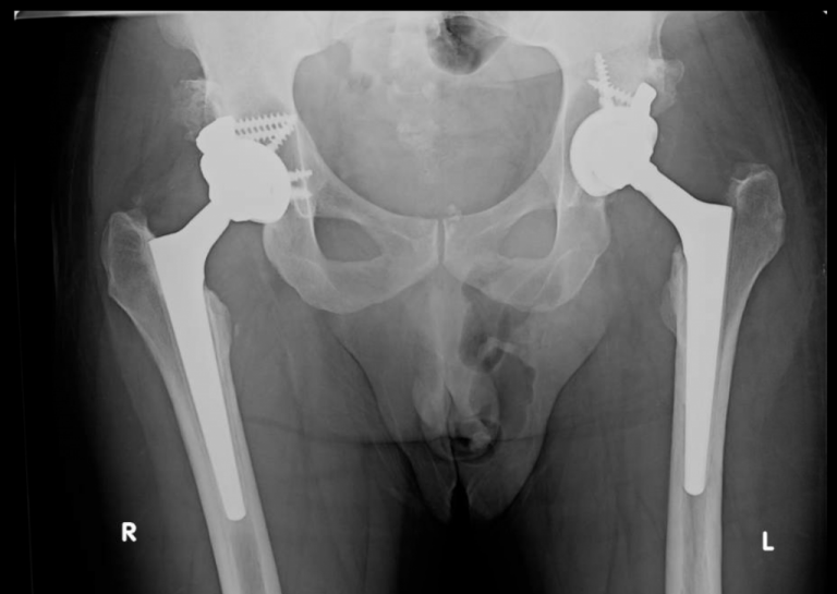 Severe Hip Dysplasia THA Darwin Chen, MD