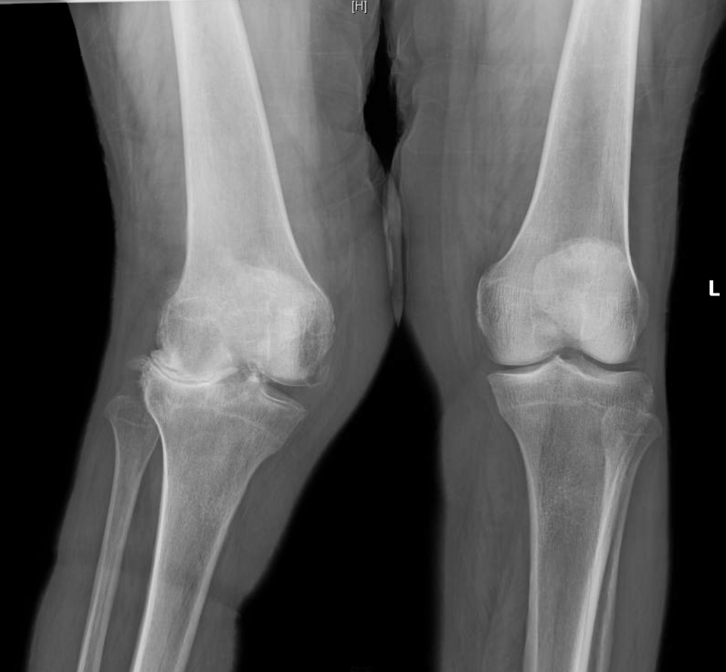TKA for Severe Valgus Deformity Darwin Chen, MD