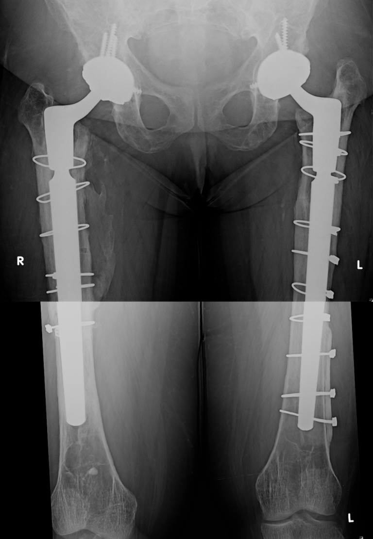 Bilateral THA revision for severe varus remodeling – Darwin Chen, MD