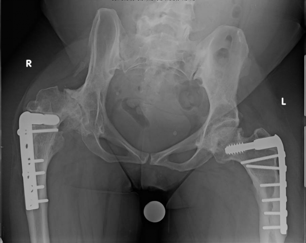 Complex THA for Proximal Femoral Deformity – Darwin Chen, MD