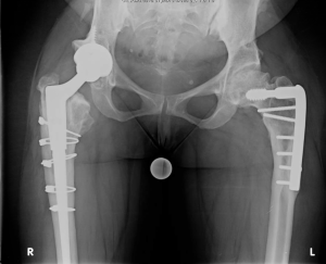 Complex THA for Proximal Femoral Deformity – Darwin Chen, MD